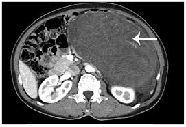 Retroperitoneal sarcoma treatment in Pune Retroperitoneal sarcoma treatment in Pune