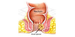 analcanalcancer