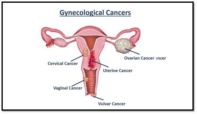 Gynecologic Cancer1