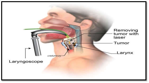 throat cancer1