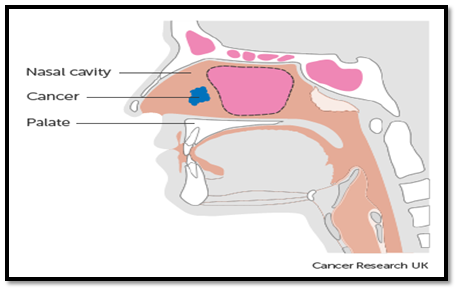 throat cancer2
