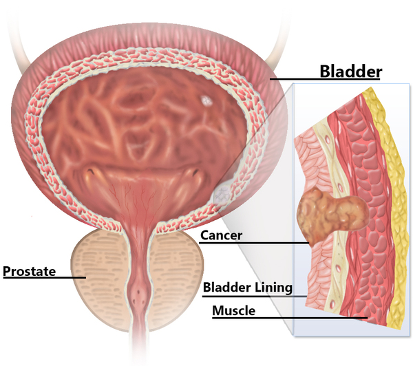 Bladder Cancer Bladder Cancer treatment in Pune