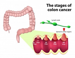 intestinal cancer treatment in pune