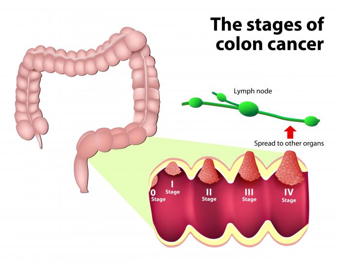 intestinal-cancer intestinal cancer treatment in pune