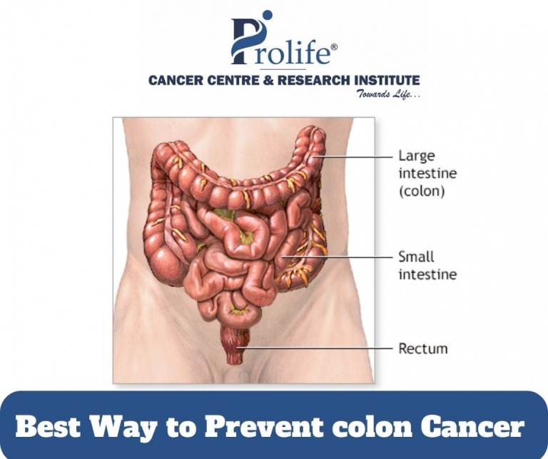 Best Way to Prevent colon Cancer Prolife Cancer Centre