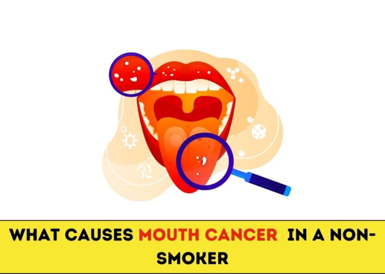 What Causes Mouth Cancer In A Non-Smoker? - Prolife Cancer Centre